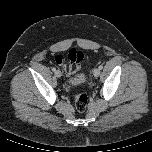 Burned-out testicular seminoma - retroperitoneal nodal metastases (Radiopaedia 62872-71245 A 63).jpg