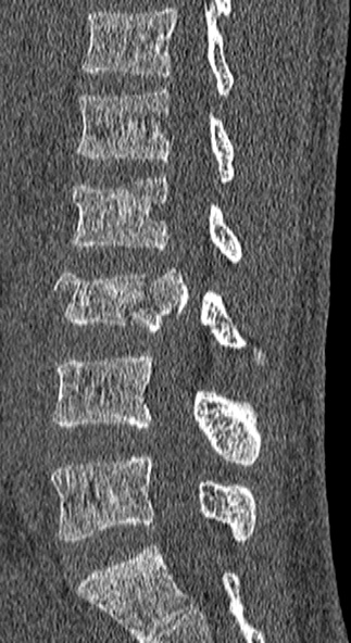 Burst fracture (Radiopaedia 53373-59357 Sagittal bone window 36).jpg
