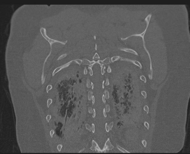File:Burst fracture - thoracic spine (Radiopaedia 30238-30865 Coronal bone window 135).jpg