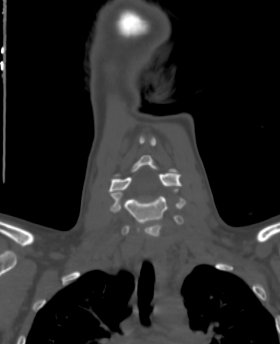 Butterfly vertebra (Radiopaedia 77903-90209 Coronal bone window 22).jpg