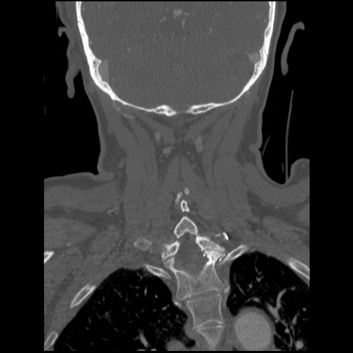 File:C1 anterior arch (plough) fracture - type 1 (Radiopaedia 76181-87720 Coronal bone window 26).jpg