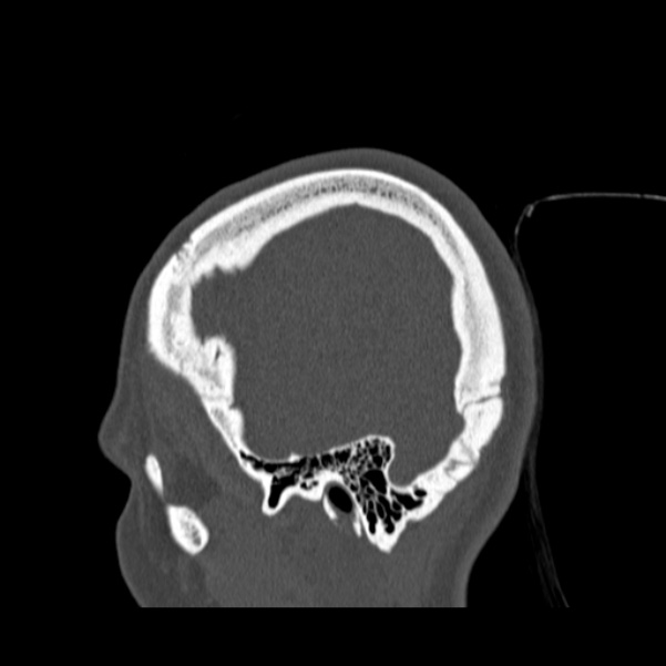 Calvarial osteoma (Radiopaedia 36520-38079 Sagittal bone window 18).jpg
