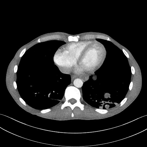 File:Cannonball metastases - testicular choriocarcinoma (Radiopaedia 84510-99891 B 81).jpg