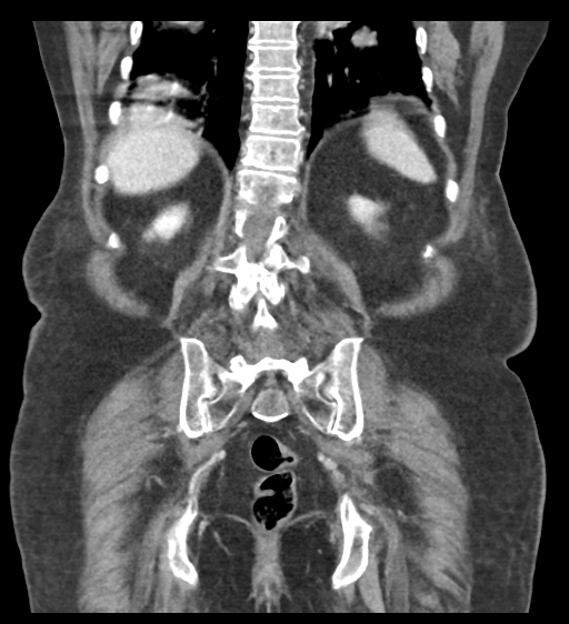 Cannonball metastases from endometrial cancer (Radiopaedia 42003-45031 F 50).png