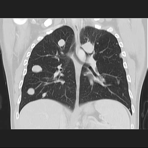 File:Cannonball pulmonary metastases (Radiopaedia 67684-77101 C 14).jpg