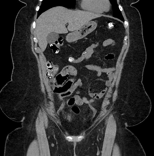 Carcinoid tumor - terminal ileum (Radiopaedia 60931-68740 Coronal non-contrast 25).jpg