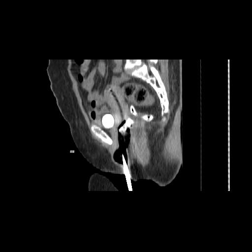 File:Carcinoma cervix- brachytherapy applicator (Radiopaedia 33135-34173 D 80).jpg