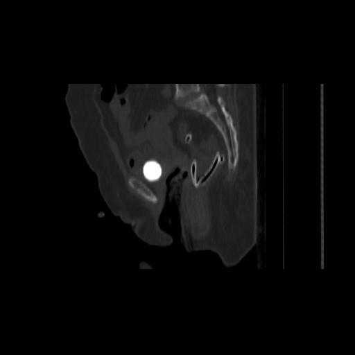 Carcinoma cervix- brachytherapy applicator (Radiopaedia 33135-34173 Sagittal bone window 100).jpg