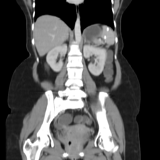 File:Carcinoma colon - hepatic flexure (Radiopaedia 19461-19493 B 25).jpg
