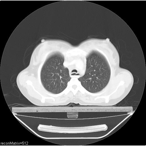 File:Carcinoma of esophagus (Radiopaedia 27356-27550 Axial lung window 25).jpg