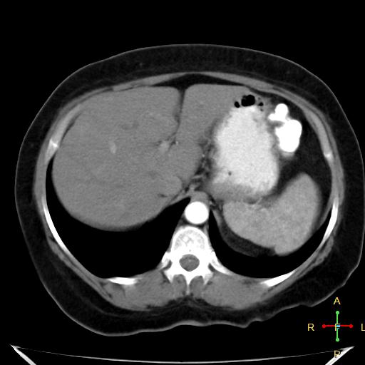 File:Carcinoma of sigmoid colon (Radiopaedia 23071-23100 C+ arterial phase 5).jpg