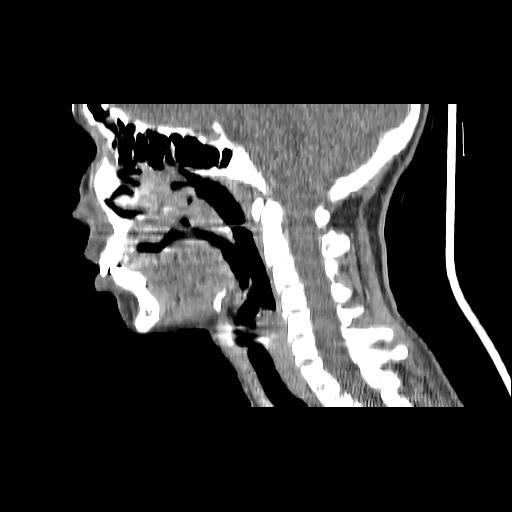 Carcinoma of the maxillary antrum (Radiopaedia 53805-59888 Sagittal C+ delayed 90).jpg