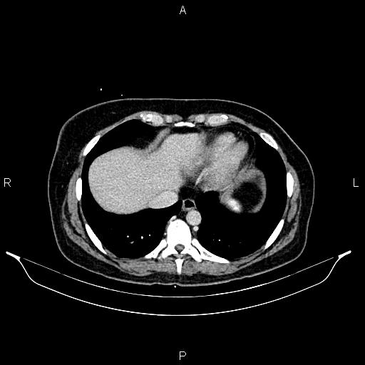 Carcinoma of uterine cervix (Radiopaedia 85861-101700 A 28).jpg