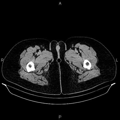 File:Carcinoma of uterine cervix (Radiopaedia 85861-101700 Axial C+ delayed 104).jpg