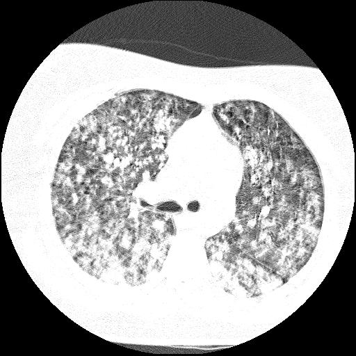 Cardiac angiosarcoma (Radiopaedia 66010-75181 Axial lung window 57).jpg