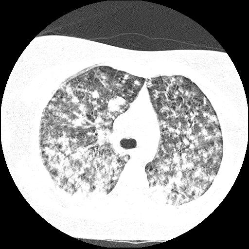 File:Cardiac angiosarcoma (Radiopaedia 66010-75181 Axial lung window 61).jpg