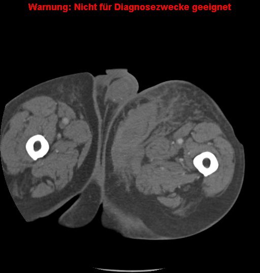File:Cardiac perforation following transcatheter aortic valve implantation (Radiopaedia 23714-23863 B 33).png