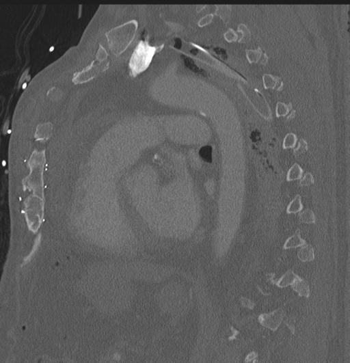 Cardiac trauma (Radiopaedia 32874-33858 Sagittal bone window 19).jpg