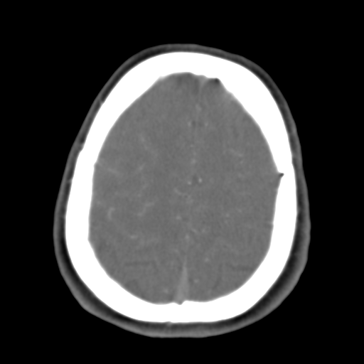 Carotico ophthalmic aneurysm (Radiopaedia 42916-46148 A 12).png