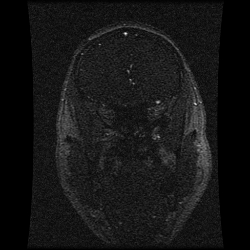 Carotid arterial dissection with acute cerebral infarction (Radiopaedia 26636-26784 MRV 123).jpg