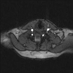 Carotid artery dissection (Radiopaedia 28441-28689 Axial MRA 21).jpg