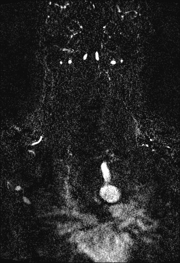 Carotid artery dissection (Radiopaedia 28441-28689 Coronal MRA 68).jpg