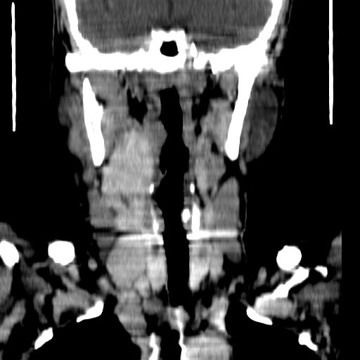 File:Carotid body tumor (Radiopaedia 27890-28124 B 11).jpg