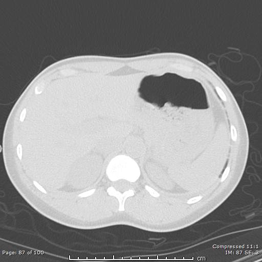 Catamenial pneumothorax (Radiopaedia 54382-60600 Axial non-contrast 87).jpg