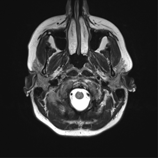 File:Cavernoma with bleed - midbrain (Radiopaedia 54546-60773 Axial T2 3).png