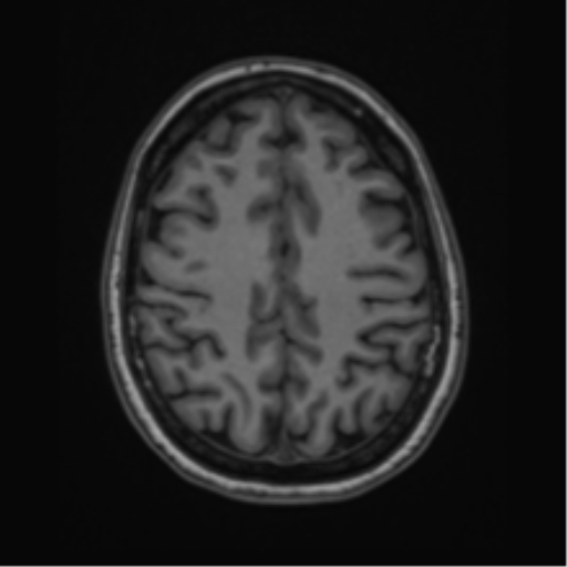 Cavernoma with bleed - midbrain (Radiopaedia 54546-60774 Axial T1 40).png
