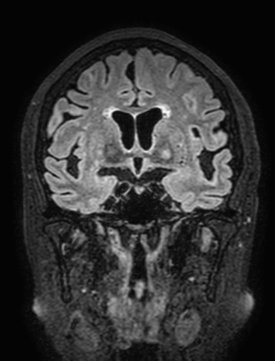 Cavernous hemangioma of the cerebellar falx (Radiopaedia 73025-83724 Coronal FLAIR 143).jpg