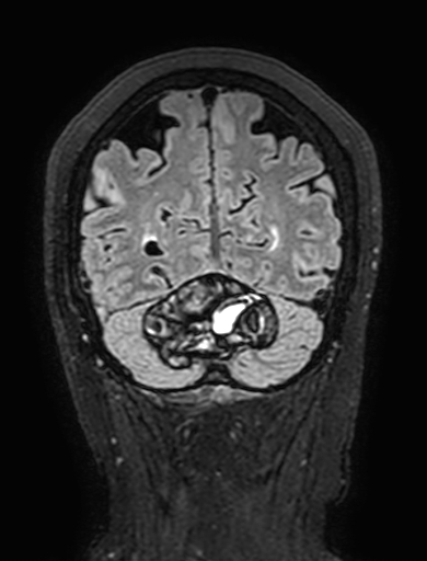 Cavernous hemangioma of the cerebellar falx (Radiopaedia 73025-83724 Coronal FLAIR 286).jpg