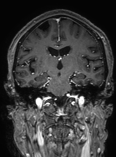 Cavernous hemangioma of the cerebellar falx (Radiopaedia 73025-83724 Coronal T1 C+ 200).jpg