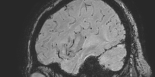 Cavernous hemangioma of the cerebellar falx (Radiopaedia 73025-83724 Sagittal BOLD 39).jpg