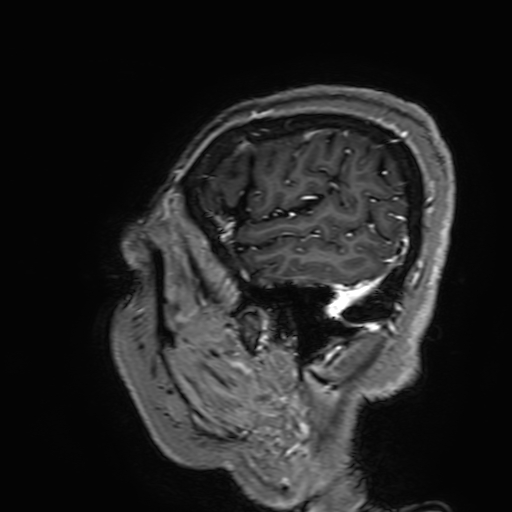 Cavernous hemangioma of the cerebellar falx (Radiopaedia 73025-83724 Sagittal T1 C+ 185).jpg