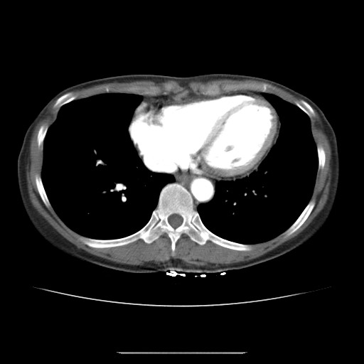 Cavernous hepatic hemangioma (Radiopaedia 75441-86667 A 1).jpg