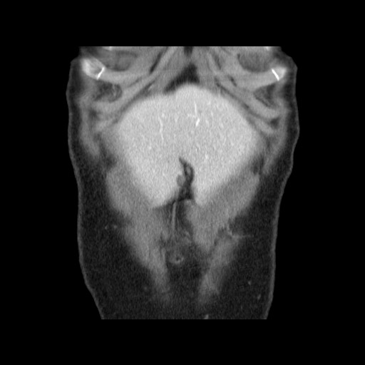 Cavernous hepatic hemangioma (Radiopaedia 75441-86667 C 22).jpg