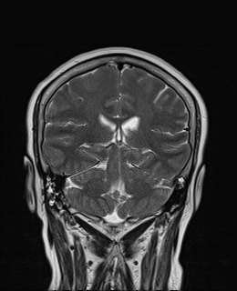 File:Cavernous sinus meningioma (Radiopaedia 63682-72367 Coronal T2 13).jpg