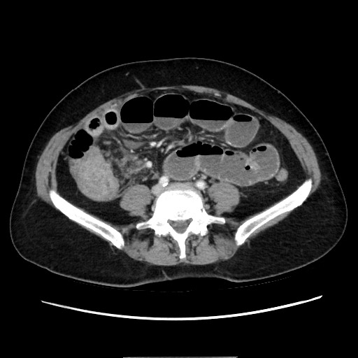 Cecal adenocarcinoma (Radiopaedia 75909-87331 A 57).jpg