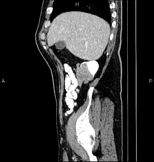 Cecal adenocarcinoma (Radiopaedia 85324-100916 E 16).jpg