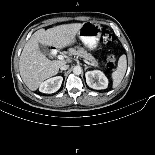 Cecal cancer with appendiceal mucocele (Radiopaedia 91080-108651 B 33).jpg