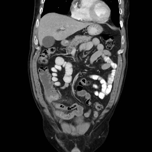 File:Cecal mass causing appendicitis (Radiopaedia 59207-66531 B 17).jpg
