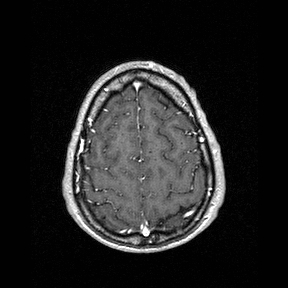 File:Central-variant posterior reversible encephalopathy syndrome (PRES) (Radiopaedia 43880-47358 Axial T1 C+ 144).jpg