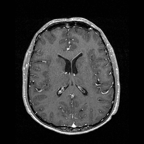 Central-variant posterior reversible encephalopathy syndrome (PRES) (Radiopaedia 43880-47358 Axial T1 C+ 96).jpg
