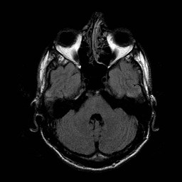 File:Central-variant posterior reversible encephalopathy syndrome (PRES) (Radiopaedia 43880-47359 Axial FLAIR 5).jpg