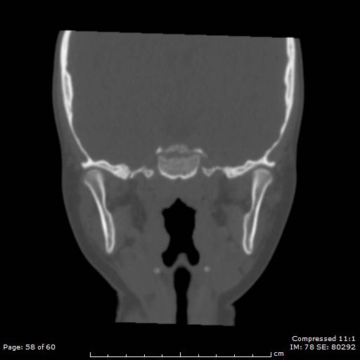 File:Central giant cell granuloma (Radiopaedia 45612-49754 Coronal bone window 58).jpg
