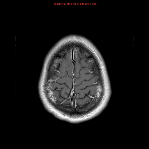 File:Central nervous system vasculitis (Radiopaedia 8410-9235 Axial T1 C+ 22).jpg
