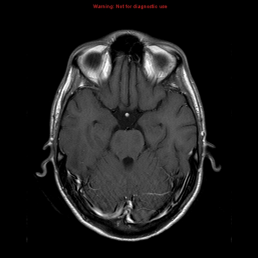 File:Central nervous system vasculitis (Radiopaedia 8410-9235 Axial T1 C+ 8).jpg