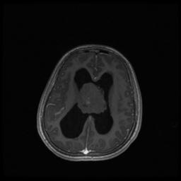 Central neurocytoma (Radiopaedia 30220-30842 Axial T1 C+ 95).jpg