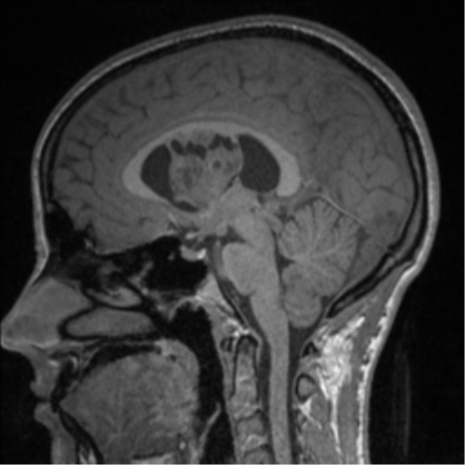 Central neurocytoma (Radiopaedia 37664-39557 Sagittal T1 49).png